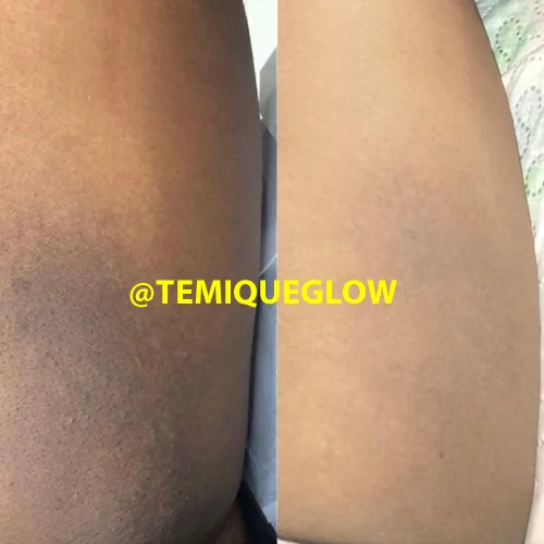 Silky smooth skin after Temique