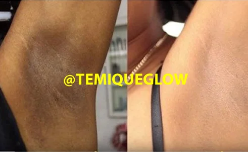 Before and After Temique — Halima