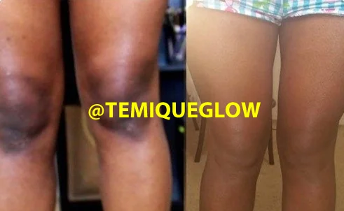 Before and After Temique — Yemisi